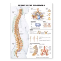 Human Spine Disorders Anatomical Chart Human Spine Disorders Anatomical Chart
